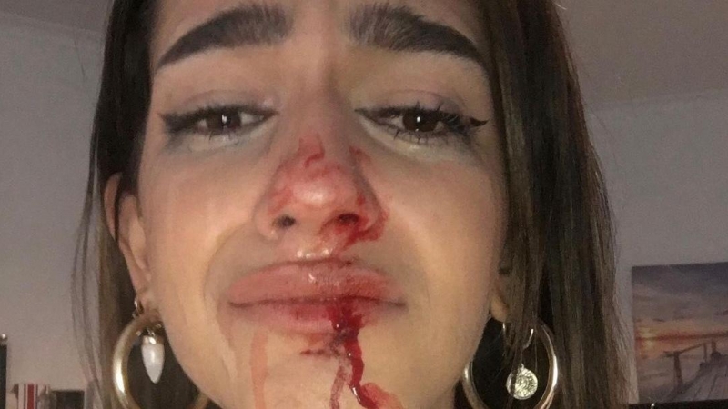 Eva muestra sus heridas tras la agresión tránsfoba. - Twitter de Eva