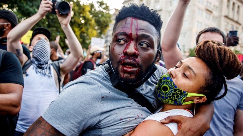 Uno de los manifestantes que resultaron heridos durante los enfrentamientos con la policía en protesta al arresto y posterior muerte de George Floyd ocurridos en las cercanías de la Casa Blanca el pasado 30 de mayo