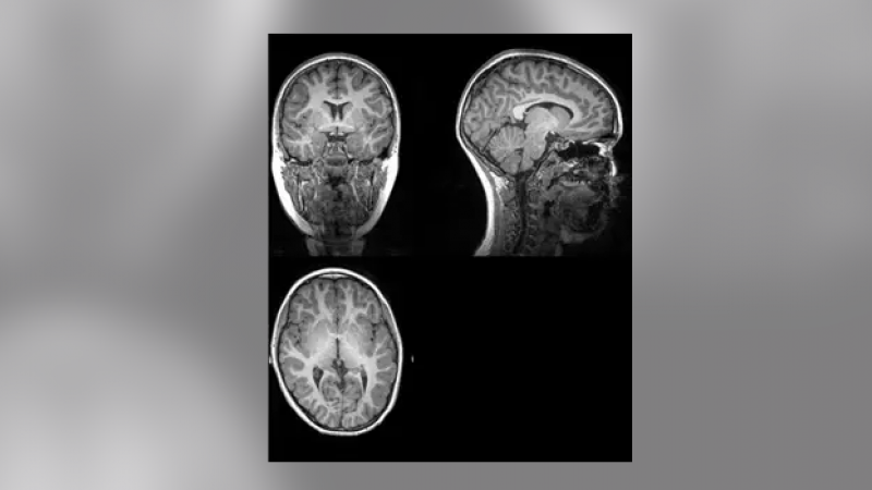 Ejemplo de imagen original de la resonancia magnética a partir de la cual investigadores de la UGR han extraído la cantidad total de materia gris, materia blanca, y cantidad total cerebral - UGR