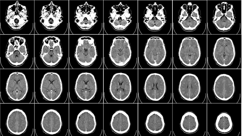 Imagen de un cerebro a través de los Rayos X.