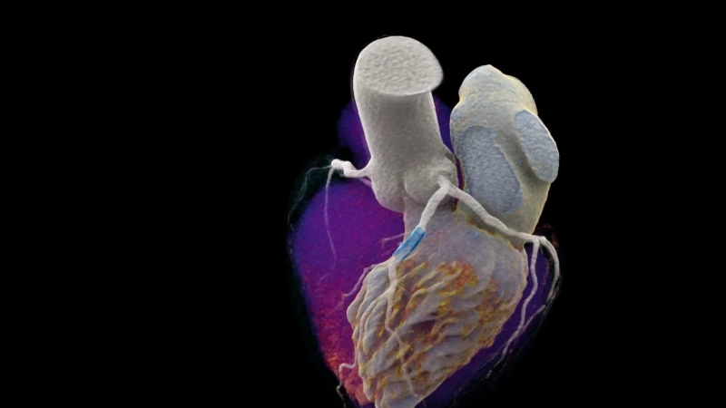 Imagen del corazón con el nuevo escáner que cuenta fotones.