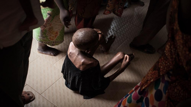 07/06/2022. Un niño desnutrido en el centro de pediatría de Bangui en la República Centroafricana, a 4 de diciembre de 2018.