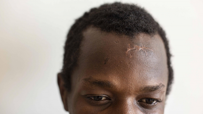 Abdulá Hamal, sudanés de 21 años, fue devuelto en caliente el 24 de marzo tras cruzar la valla de Melilla. En su frente se ve la cicatriz que un guardia civil le hizo en un intento previo de saltar la valla el pasado marzo.