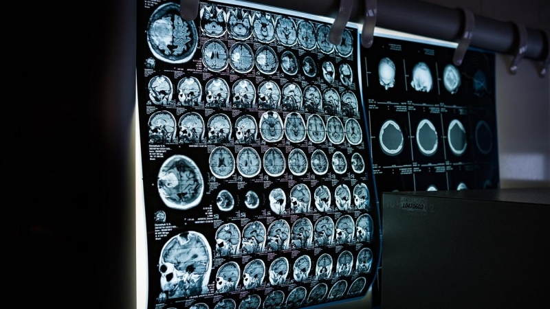 Una resonancia magnética muestra un cerebro humano