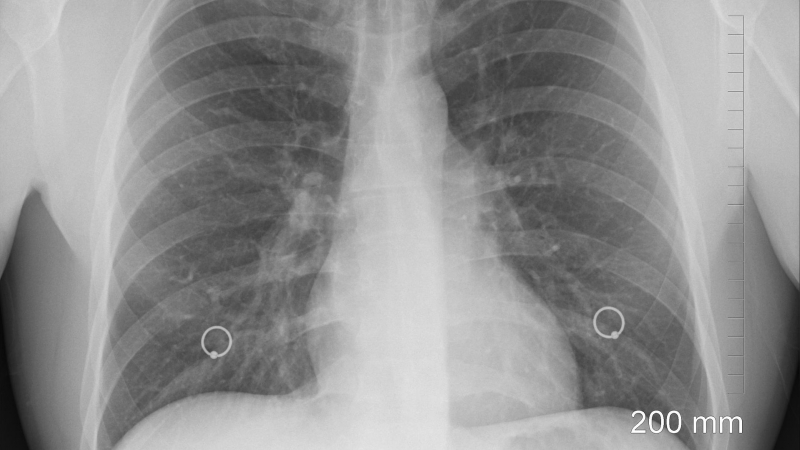 Radiografía de unos pulmones
