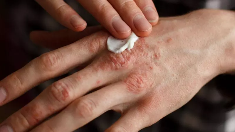 Una mano con lesiones de psoriasis en una foto de archivo.