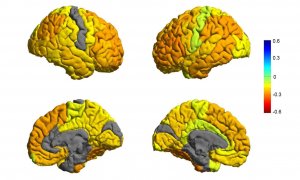 Representación de cerebros con trastorno bipolar