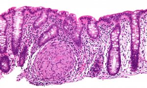 Biopsia endoscópica donde se puede apreciar inflamación granulomatosa del colon en un caso de enfermedad de Crohn. WIKIPEDIA