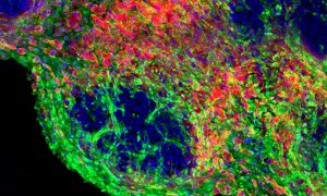 Imagen por inmunofluorescencia de un tumor ex vivo, que muestra células tumorales (azul), rodeadas por una matriz de colágeno (verde) y fibroblastos (magenta). El microambiente tumoral está compuesto por diversos tipos de células que participan en el inic