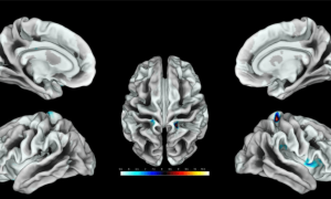 Ubicación de la región del cerebro activada por estimulación del clítoris en un grupo de mujeres.