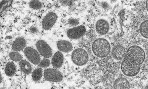 Imagen microscópica de la viruela del mono.