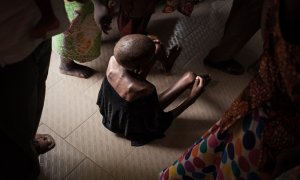 07/06/2022. Un niño desnutrido en el centro de pediatría de Bangui en la República Centroafricana, a 4 de diciembre de 2018.