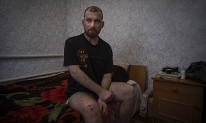 Alexander Ogorodnik, de 29 años y diagnosticado con un tumor cerebral, posa en su habitación en el sur de la provincia de Járkiv, donde recibe a 'Público'