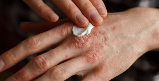 Un futuro libre de psoriasis es (casi) posible