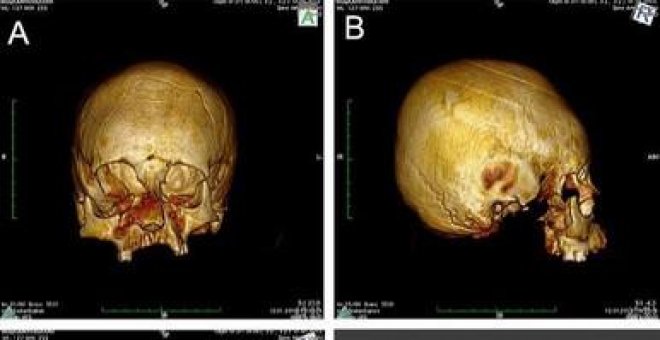 Hallan cráneos con deformación artificial de hace 1.500 años en Europa