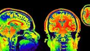 ¿Cambia la psicoterapia el cerebro?