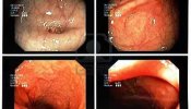 La colonoscopia, única prueba que diagnostica con total precisión el cáncer de colon