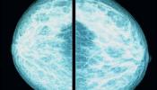 ¿Reduce la mamografía la mortalidad por cáncer?