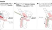 Las operaciones para alargar el pene se disparan