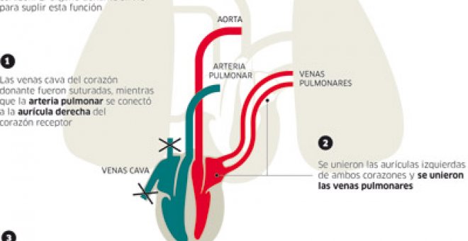 La niña que vivió con dos corazones ya sólo usa uno