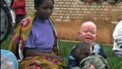 El drama de ser albino en Tanzania