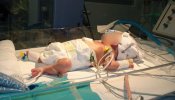 Operado con éxito un bebé prematuro de 1.375 gramos con una grave cardiopatía