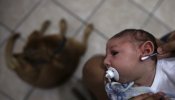 Sanidad confirma un segundo caso de malformación cerebral en un feto por Zika