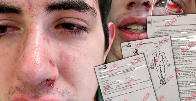 Terrible paliza a un joven con síndrome de Tourette al grito de "subnormal" en Argamasilla de Alba