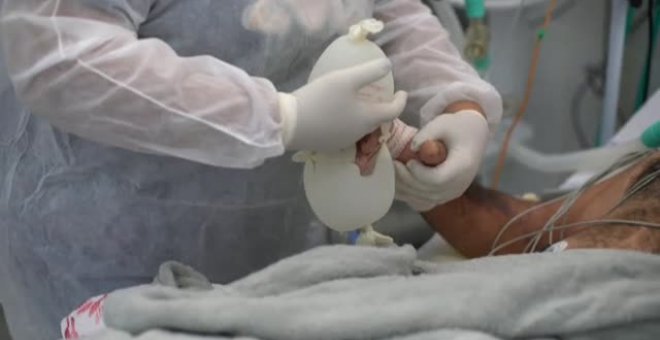 Los hospitales de Brasil recurren a la técnica  'manitas de amor' que son guantes de látex llenos de agua tibia
