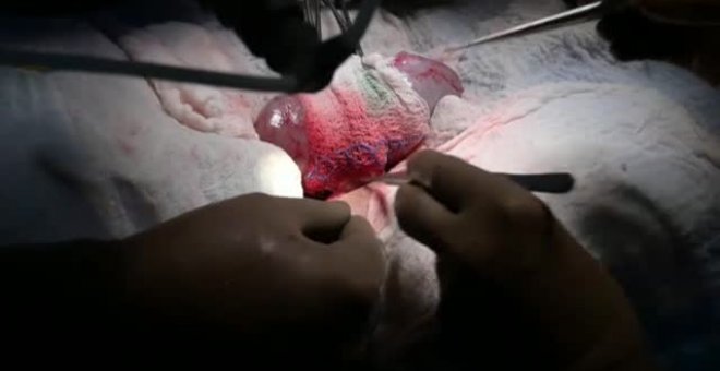Se trasplanta con éxito el riñón de cerdo a una mujer en muerte cerebral