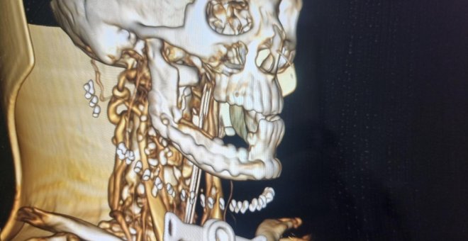 Diez horas de operación y técnicas novedosas para reconstruir la mandíbula de una paciente oncológica en Albacete