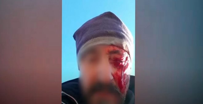 Pierde un ojo al ser agredido por dos cazadores a quienes llamó la atención por disparar junto a varias casas de Toledo