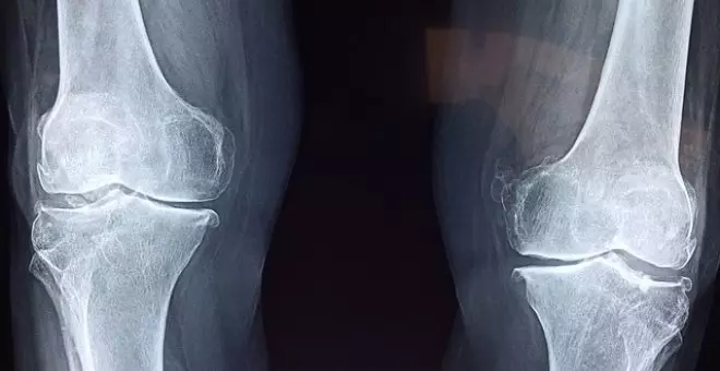 Pato confinado - Osteoporosis: una amenaza para los huesos que puede mitigarse con la dieta